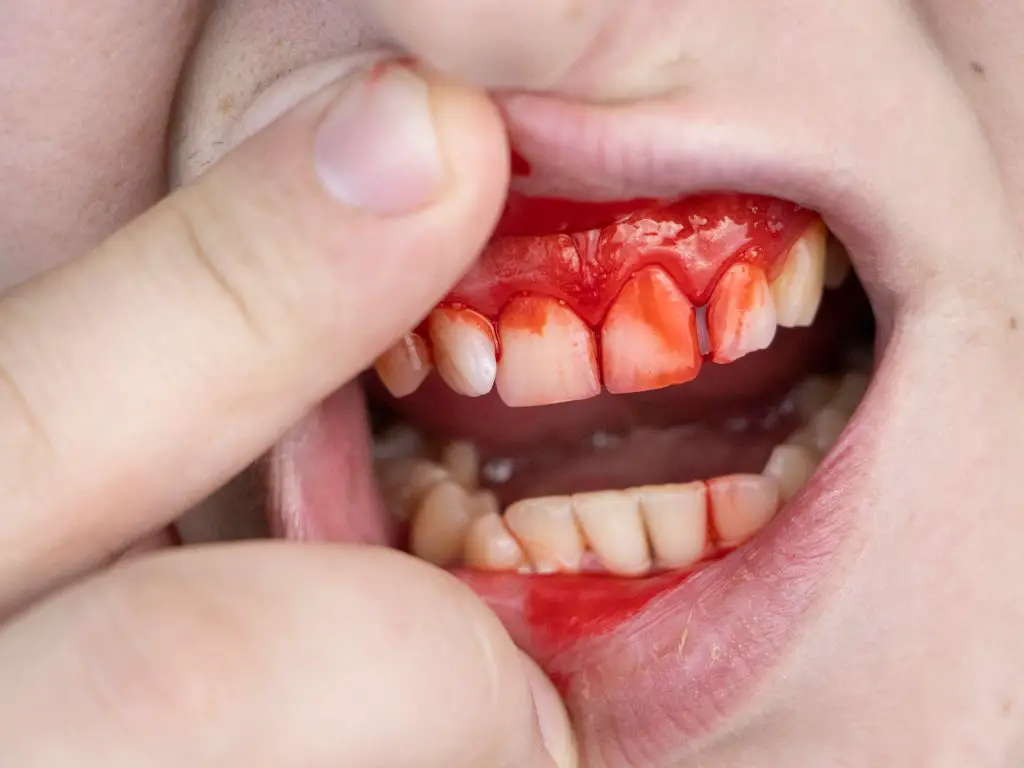Gum disease that can kill you