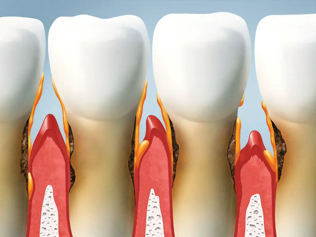 Tooth loss