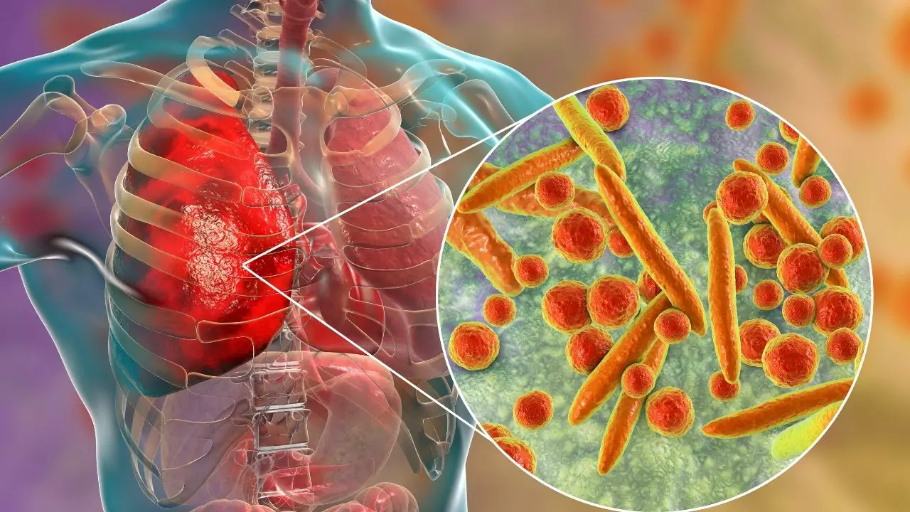 Lipoid pneumonia