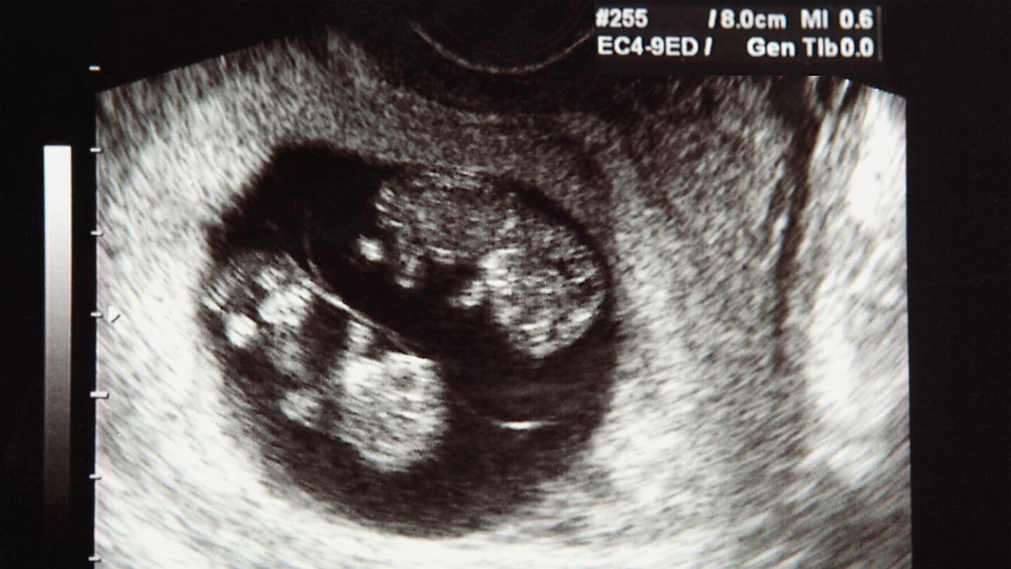 identical twins formation